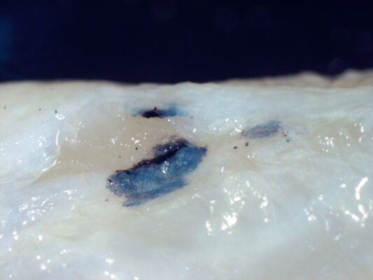 Daggertooth Pike Conger (Muraenesox cinereus) |commons:File:Huffmanela hamo eggs in Muraenesox cinereus 1B.JPG